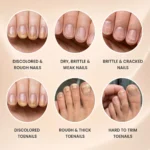 Thick, dry, rough and brittle-looking nails suitable for targeted urea 40 nail gel care