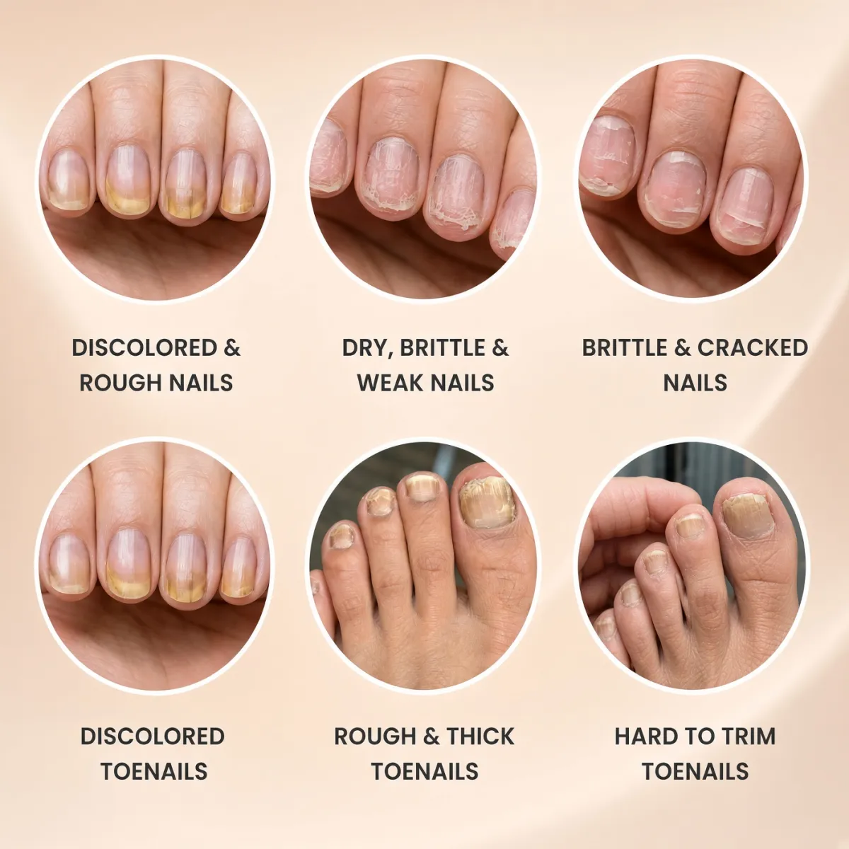 Thick, dry, rough and brittle-looking nails suitable for targeted urea 40 nail gel care