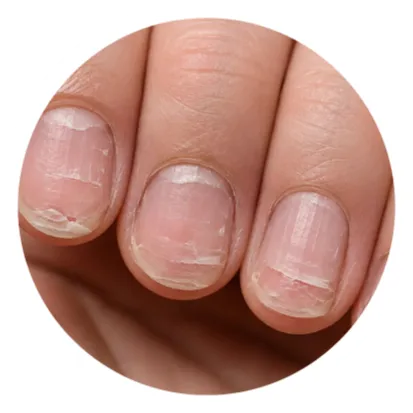 Home brittle cracked nails needing nail repair treatment
