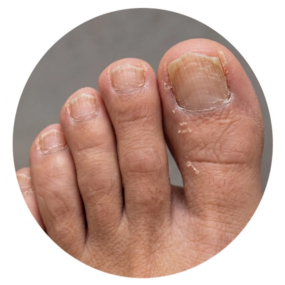 Home rough thick toenails with thick toenail care treatment