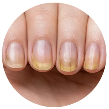 Home Thick, rough-looking fingernails needing targeted nail care