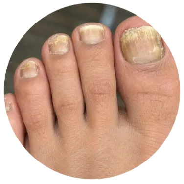 Home Toenails showing yellow discoloration and uneven appearance