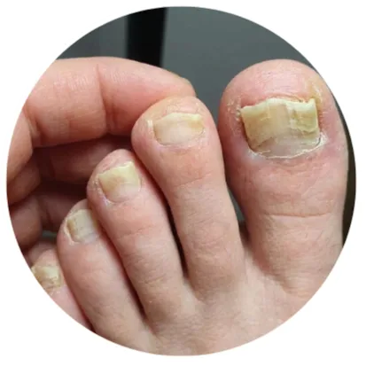 Home Thick, hard-to-trim toenails with uneven nail surfaces
